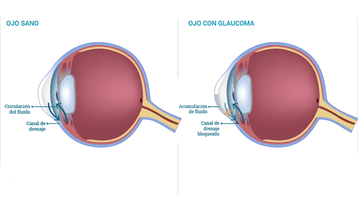 A patient's perspective: living with glaucoma and using brinzolamide