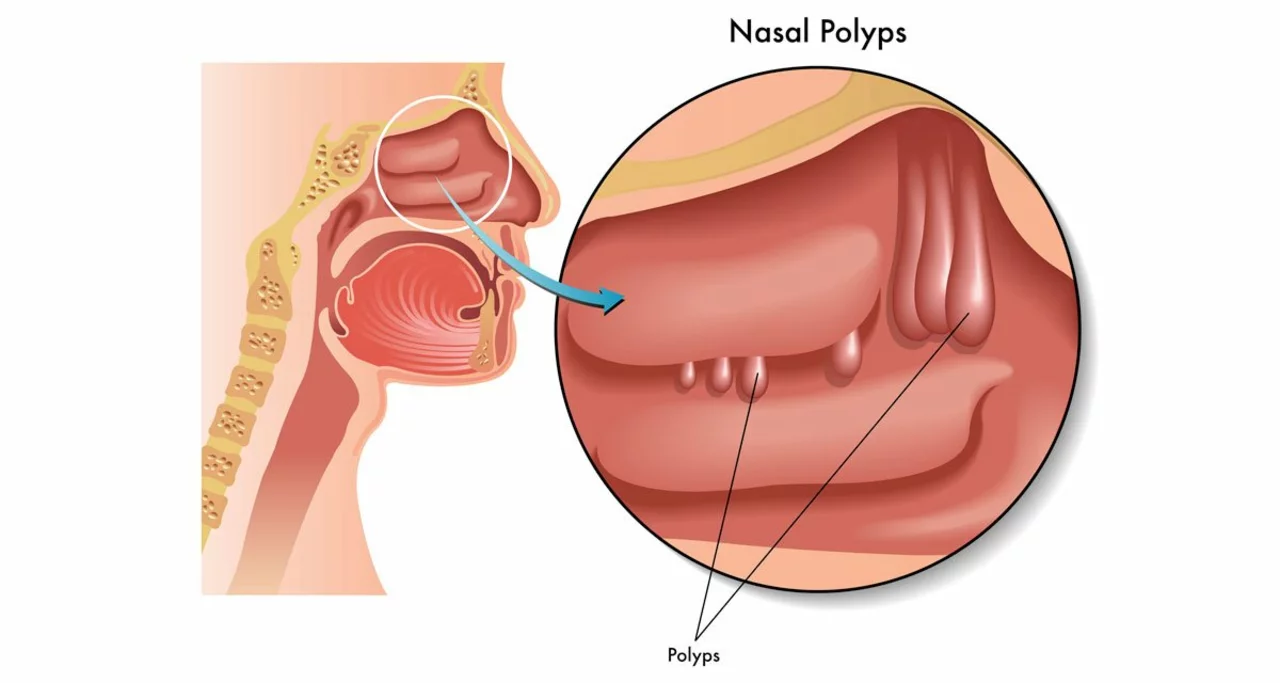 The use of beclomethasone in treating nasal polyps